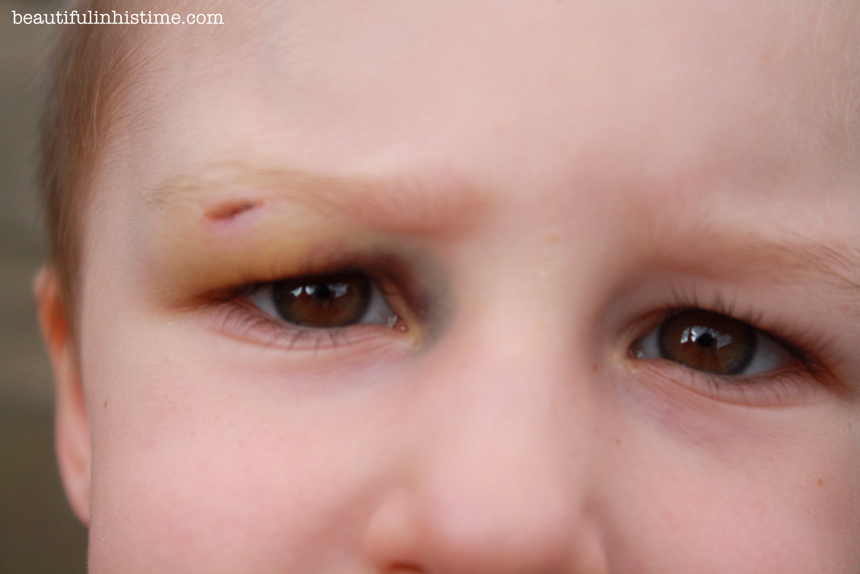 healing black eye Beauty in the Mess Edition 07.09.13 @beautifulinhistime.com